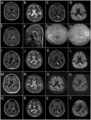 Not your usual neurodegenerative disease: a case report of neuronal intranuclear inclusion disease with unconventional imaging patterns